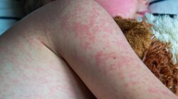 Wabah Campak Mengancam Di Lampura