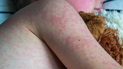 Wabah Campak Mengancam Di Lampura